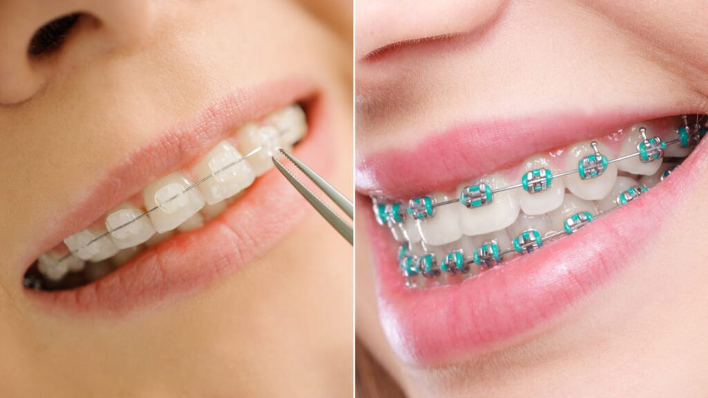 Orthodontic Treatment in Sydney | Orthoworx