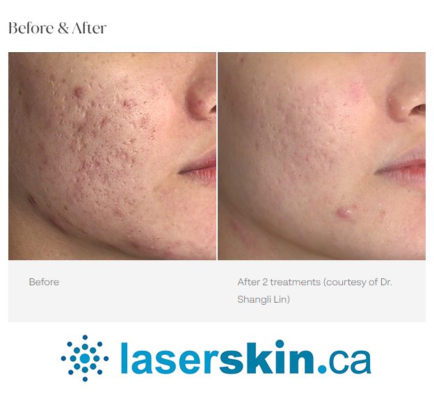 SKIN LASER