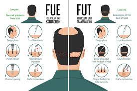 Hair Transplant Melbourne