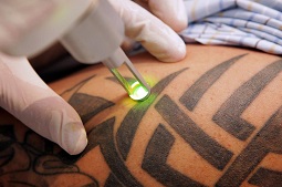 Tattoo Removal Pros Colorado Springs