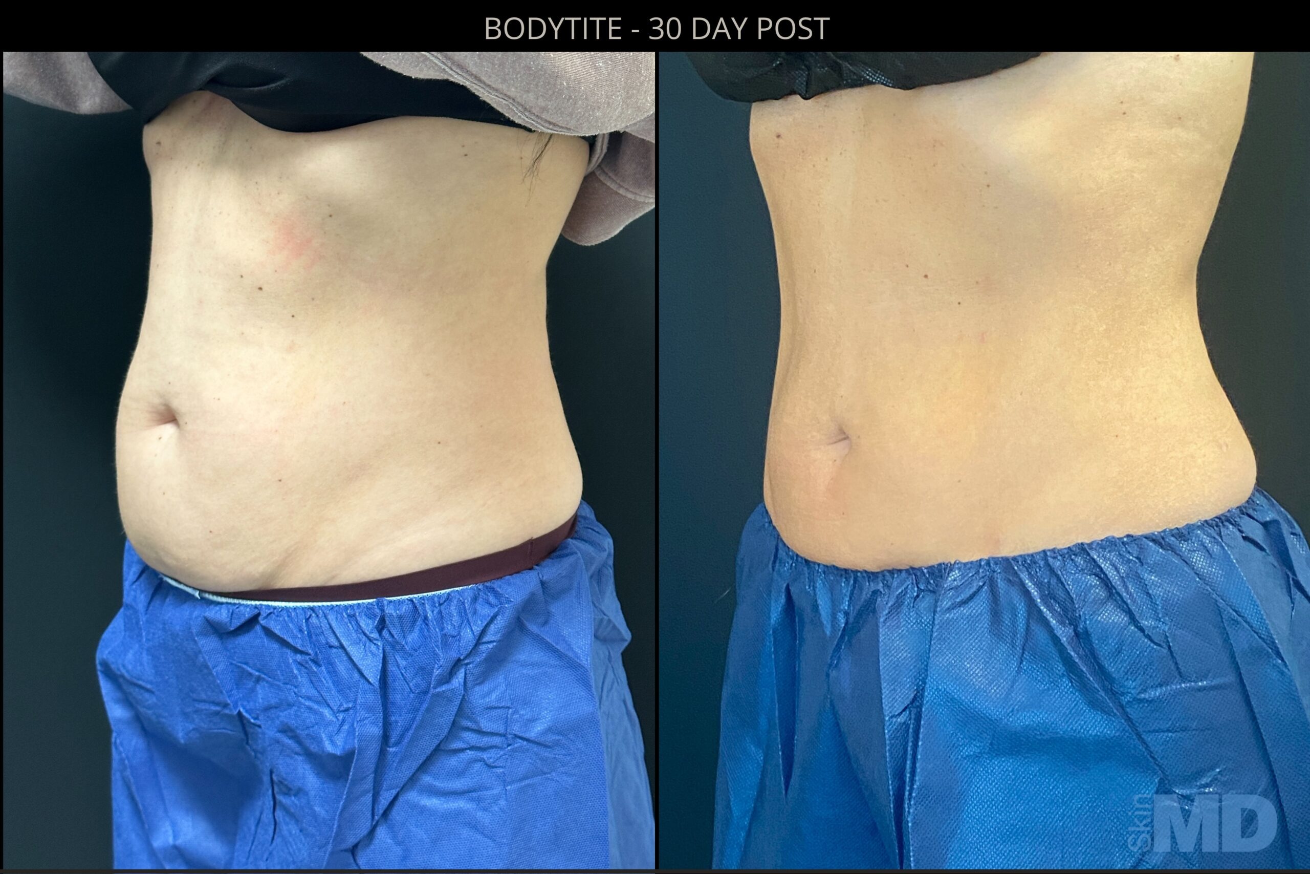 Bodytite Treatments Near Me