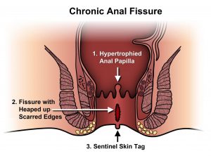 Heller’s Cardiomyotomy for Achalasia – Procedure & Treatment