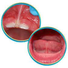 Tongue Tie Release | Integrity Dental